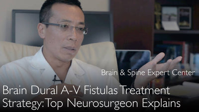 Fístula arteriovenosa dural cerebral. Tratamiento de la fístula arteriovenosa dural cerebral (FADC). 10