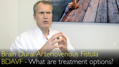 Fístula arteriovenosa dural cerebral. FAVDC. ¿Cuáles son las opciones de tratamiento? 7