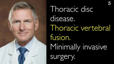 Enfermedad discal torácica. Fusión vertebral torácica. Cirugía mínimamente invasiva. 5